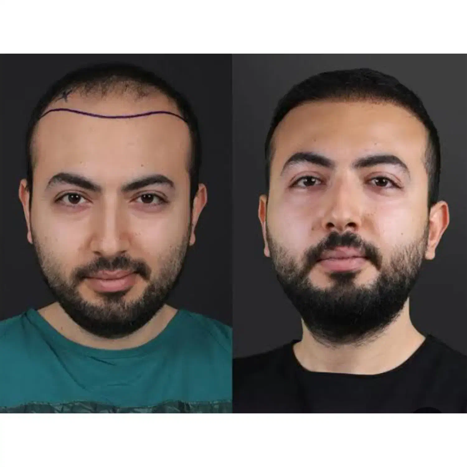 اجاره ی اتاق برای کاشت مو